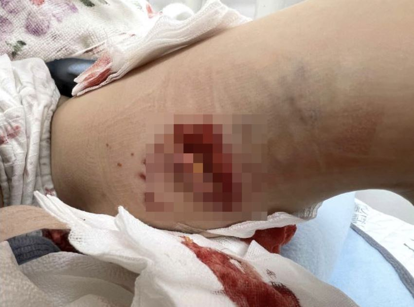  7살 딸, 풍산개 5마리에 물려 4시간 대수술..견주는 "착한 개들"