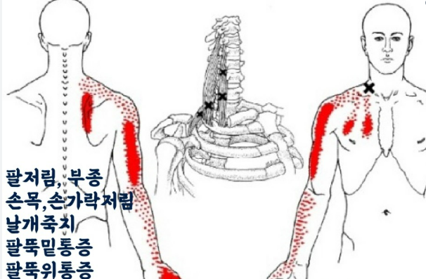 팔저림 원인
