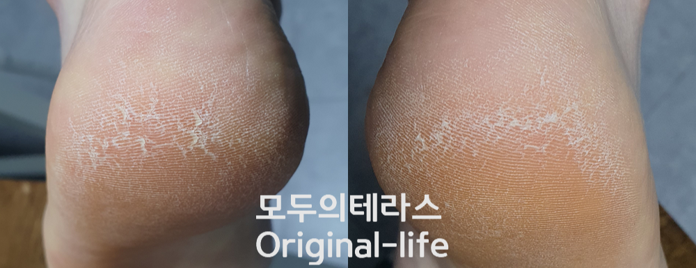 발뒤꿈치각질제거 후기 (약혐주의) 13