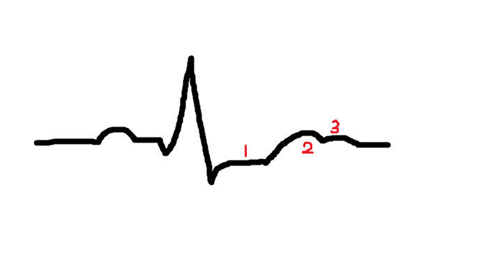 저칼륨혈증(hypokalemia), 고칼륨혈증(hyperkalemia)의 원인과 치료 저칼륨혈증(Hypokalemia), 고칼륨혈증(Hyperkalemia)의 원인과 치료