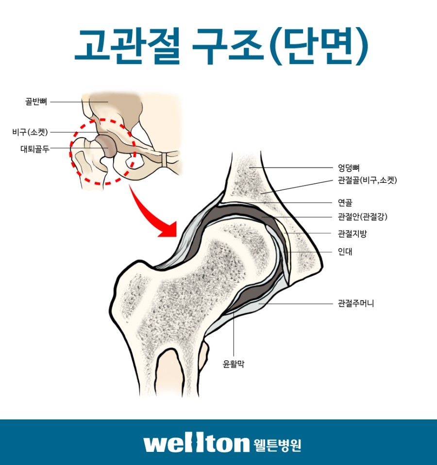 고관절 통증 원인 고관절 통증 원인
