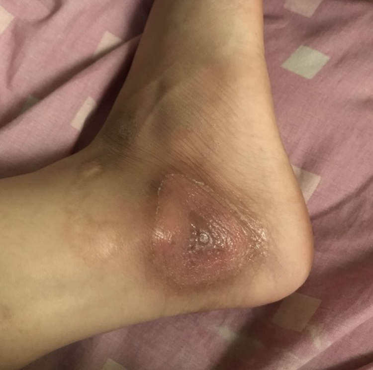  화상 흉터 연고 제발 효과가 있어라!