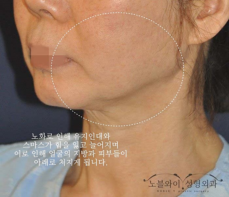  불독살없애는법 이거였구나