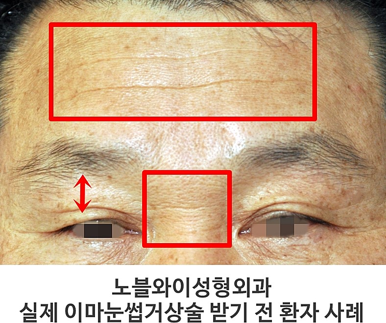  이마주름제거수술 말고 시술로는 안되나?