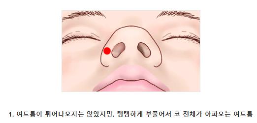  가장 고통스러운 여드름 위치는?