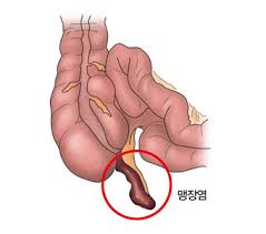 맹장의 위치과 증상