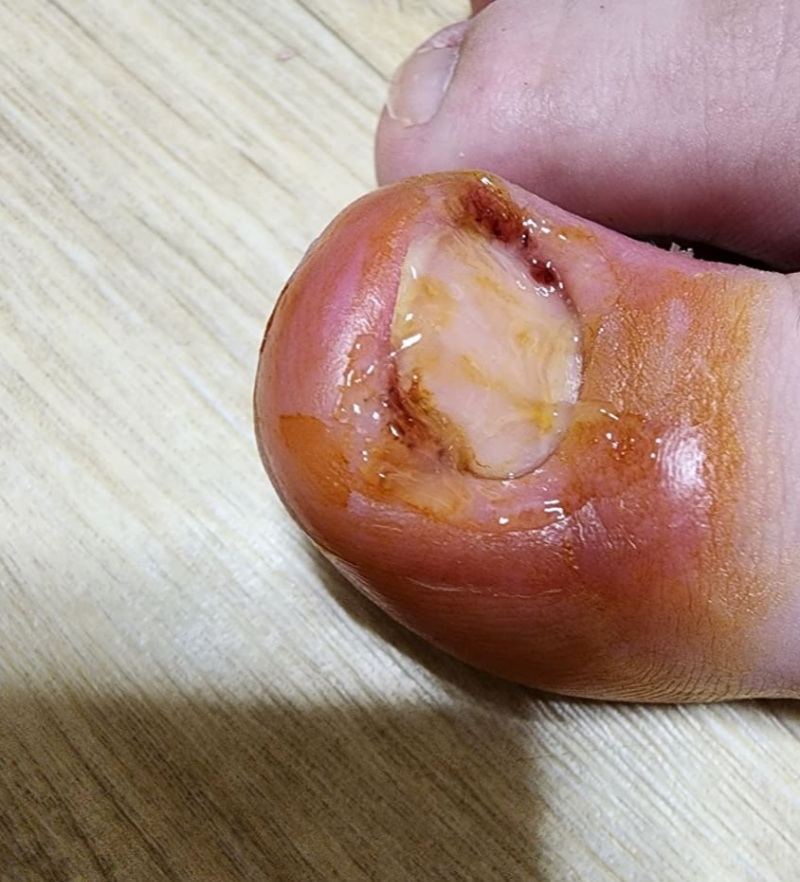 발톱을 깊게 깎아 상처난 오른쪽 엄지발가락