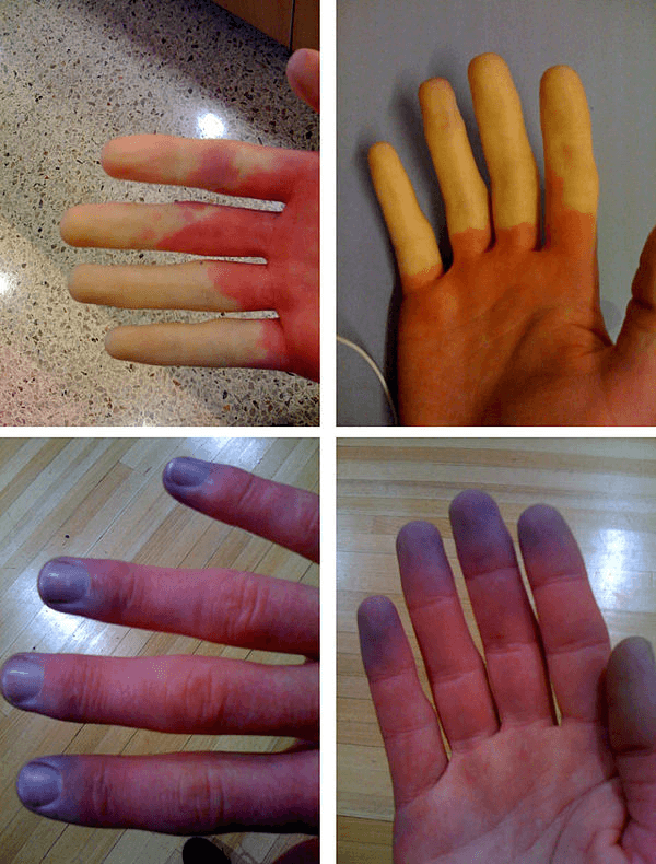 레이노현상에 영향을 받은 손 (출처 : 위키백과)