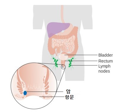  치질과 혼동하면 안되는 항문암 증상 및 치료