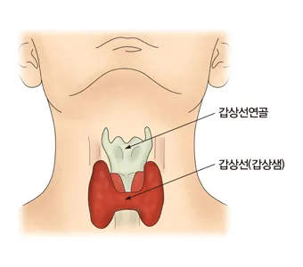 갑상샘 저하증 갑상선 기능저하증 증상 수치 치료_2