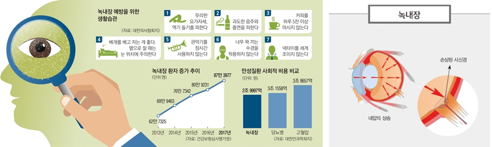 녹내장 치료방법 및 예방법