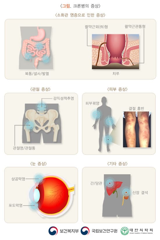 크론병-소화관-염증