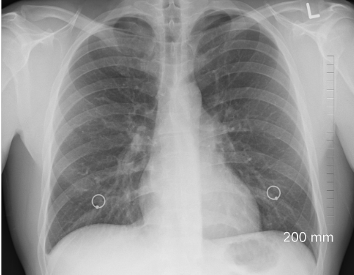 폐 엑스레이 사진