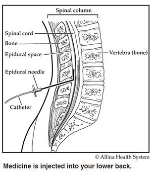 epidural cathter