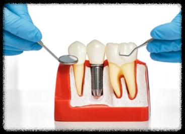 살아있는 치아와 임플란트 비교