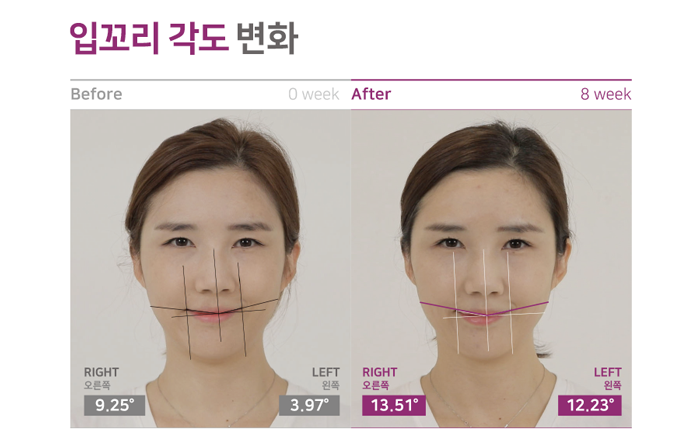 입가주름 7