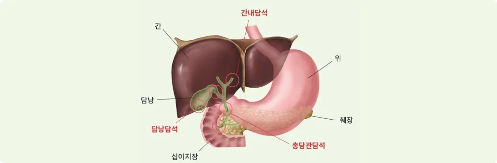 담낭 제거 수술후 먹지말아야할 음식