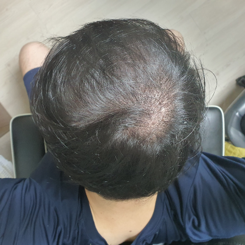  비절개 3천모 3개월 경과
