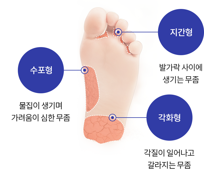  무좀 치료 방법 총정리