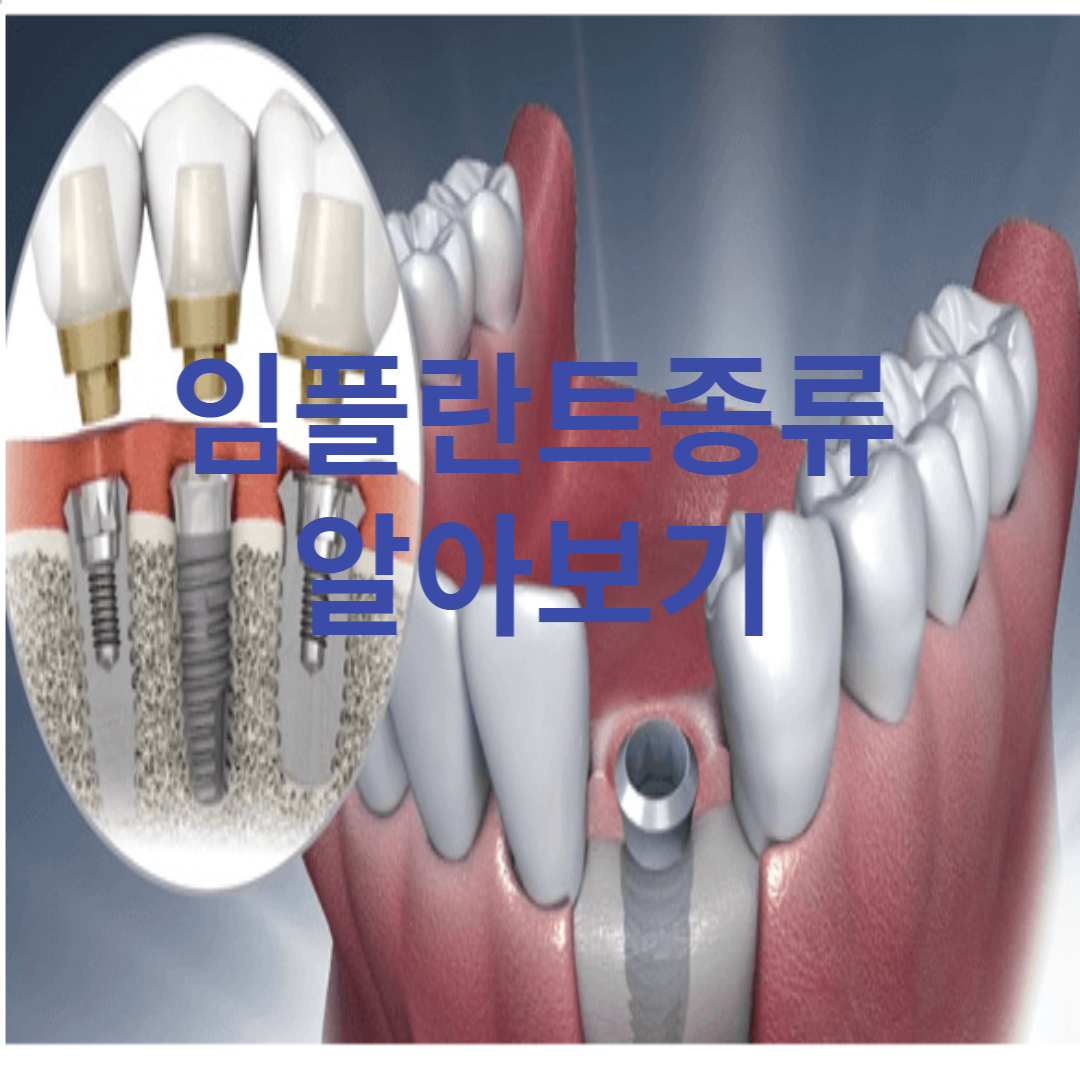  임플란트 종류알아보기 (임플란트 80만원이하)