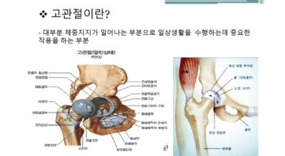 고관절 이미지