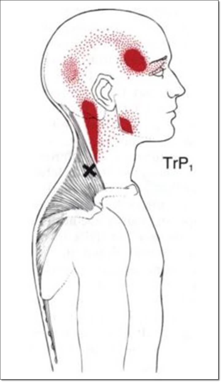 승모근으로 인해서 발생하는 두통을 나타낸 그림