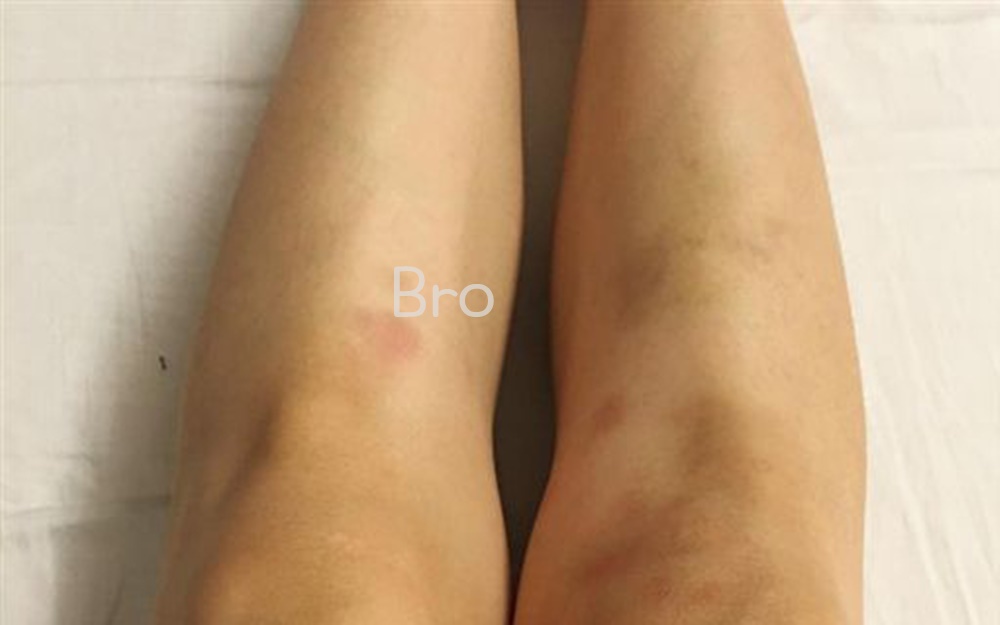 무릎에 갈색 반점이 보이는 여성이 다리를 보여준다