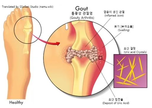 통풍이미지