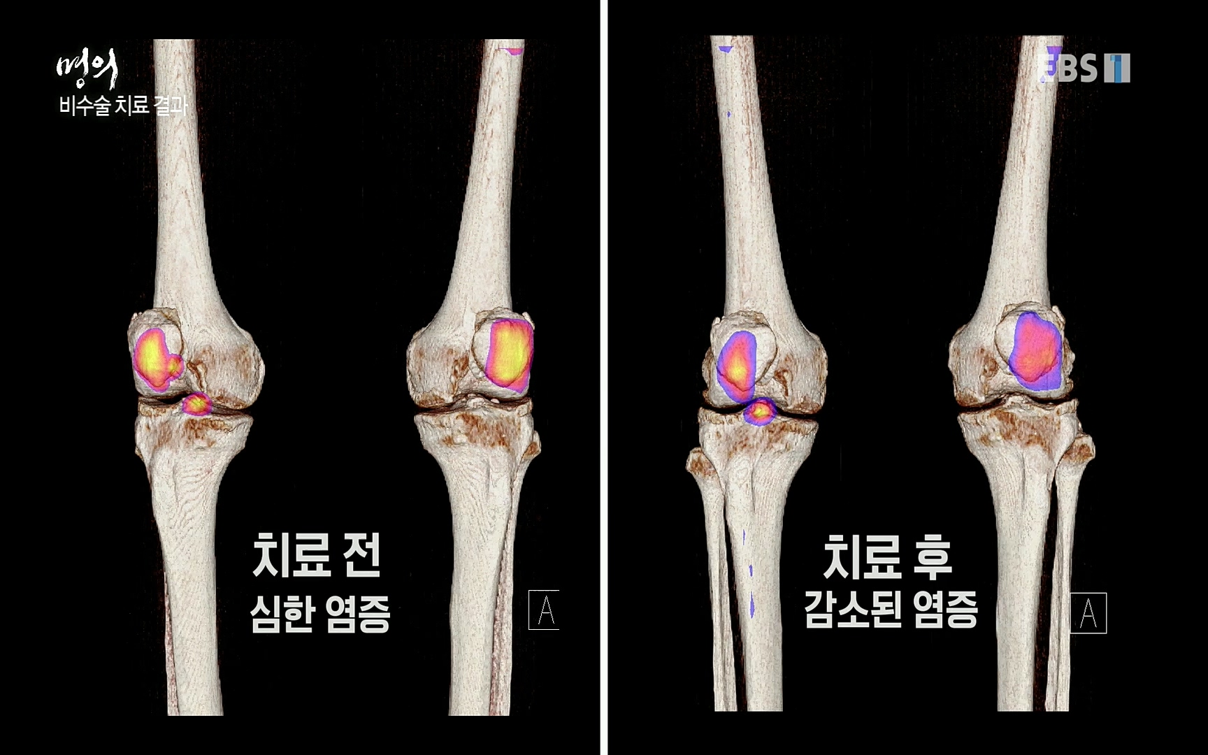 EBS 명의 헬스케어 - TV - 교육의 중심 EBS무릎 건강 프로젝트 2부 새 무릎으로 사는 법 .mp4_20220726_202352.295.jpg