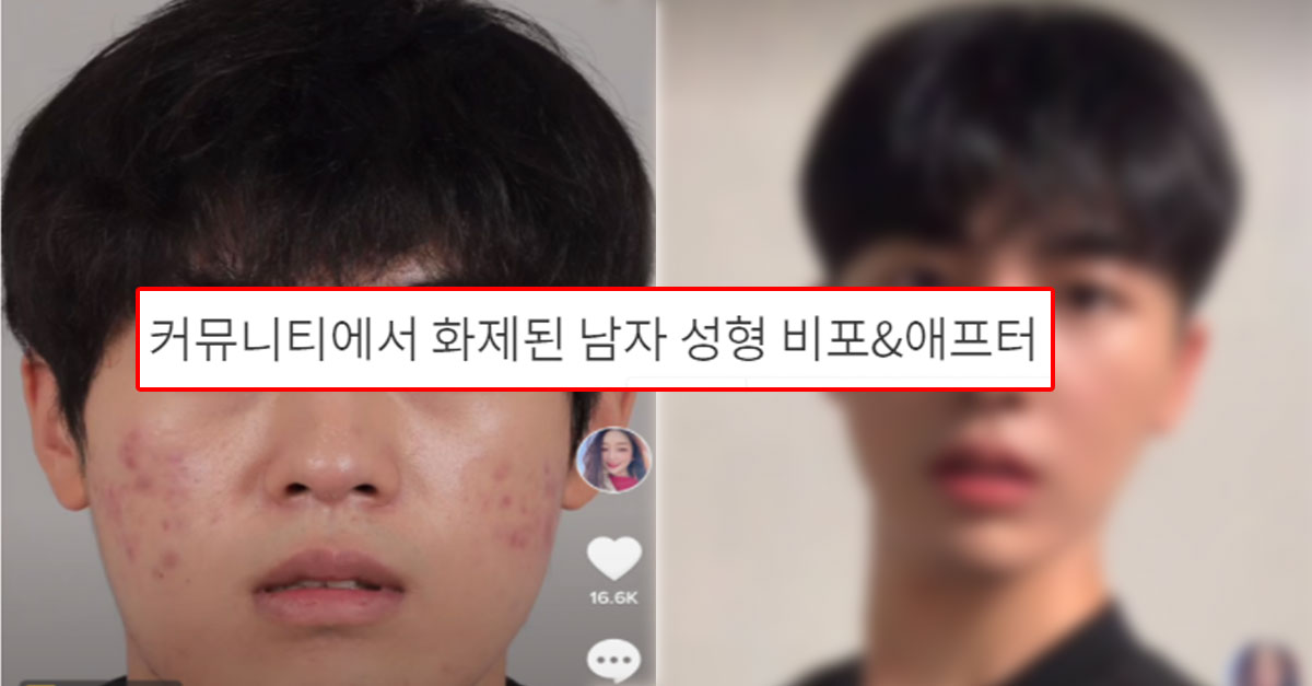  커뮤니티에서 화제된 남자 성형 비포&애프터