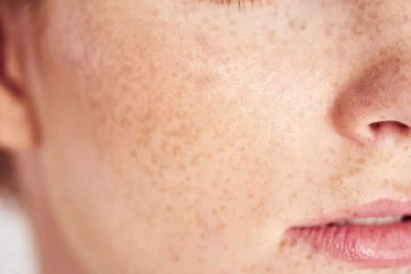  기미 없애는 방법과 좋은음식