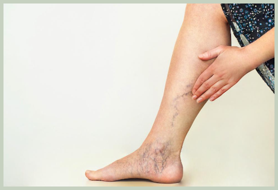 하지 정맥류 | 증상, 위험 요인, 치료법 - 1. 하지 정맥류란 무엇인가요? 하지 정맥류란?