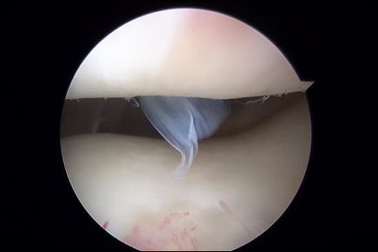 연골 손상(Cartilage Injury): 원인, 증상, 치료 방법 및 FAQ