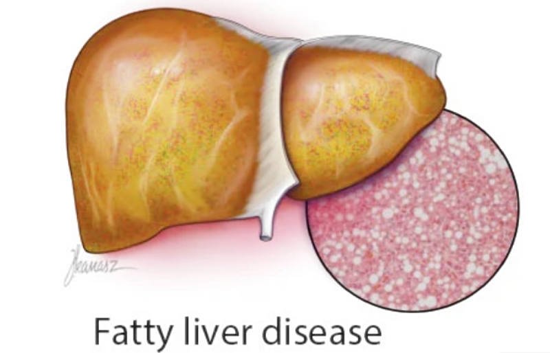 Fatty liver disase image