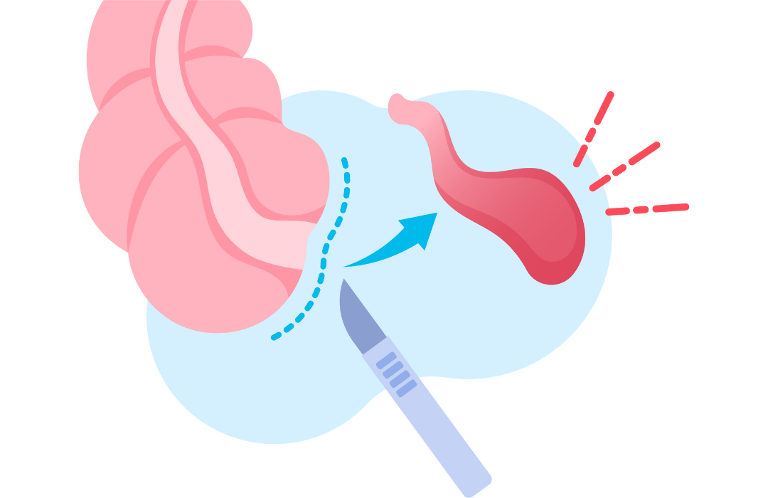 맹장염 치료 및 관리 소제목에 어울리는 충수염 제거 수술 일러스트