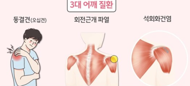 회전근개 파열, 석회성 건염