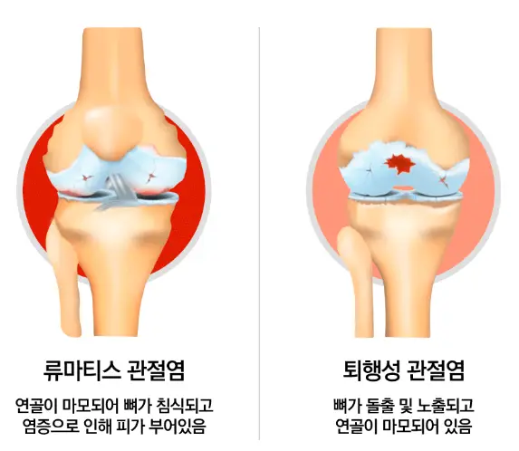 류마티스-퇴행성-관절염