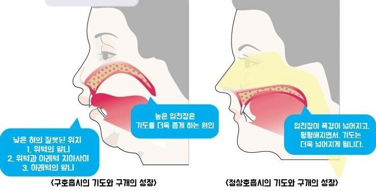 낮은 혀의 잘못된 위치
1. 위턱의 앞니
2. 위턱과 아래턱 치아사이
3. 아래턱의 앞니
높은 입천장은
기도를 더욱 좁게 하는 원인
입천장이 폭경이 넓어지고
평평해지면서. 기도는 더욱 넓어지게 됩니다.
<구호흡시의 기도와 구개의 성장>
<정상호흡시의 기도와 구개의 성장)