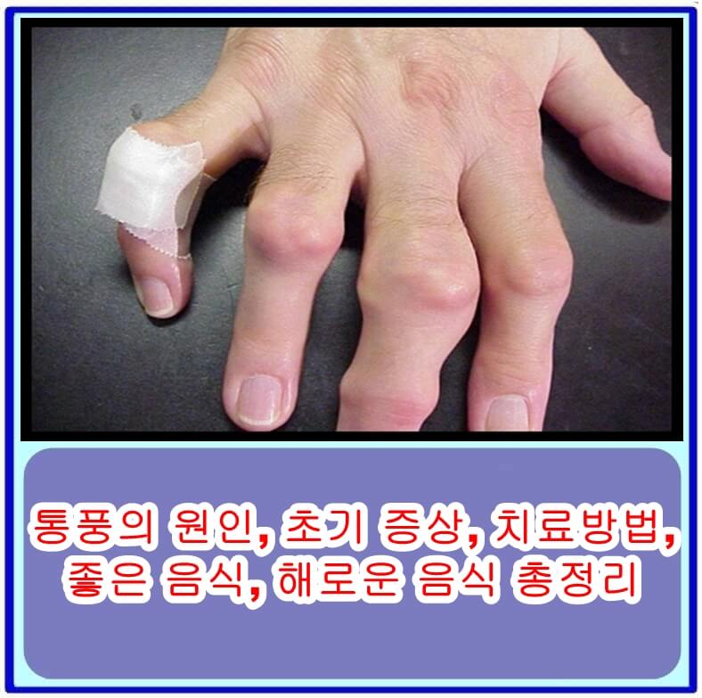  통풍의 원인, 초기 증상, 치료방법, 좋은 음식, 해로운 음식 총정리