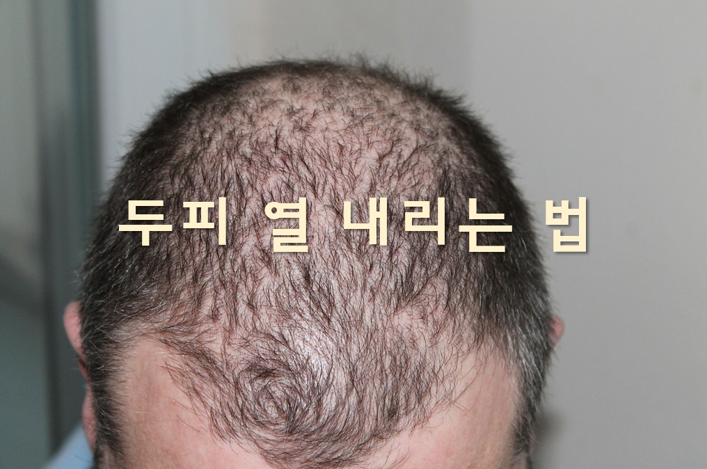  두피 열 내리는 법과 두피 건강에 좋은 음식