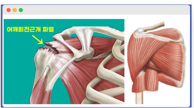 회전근개파열