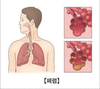 폐렴 증상