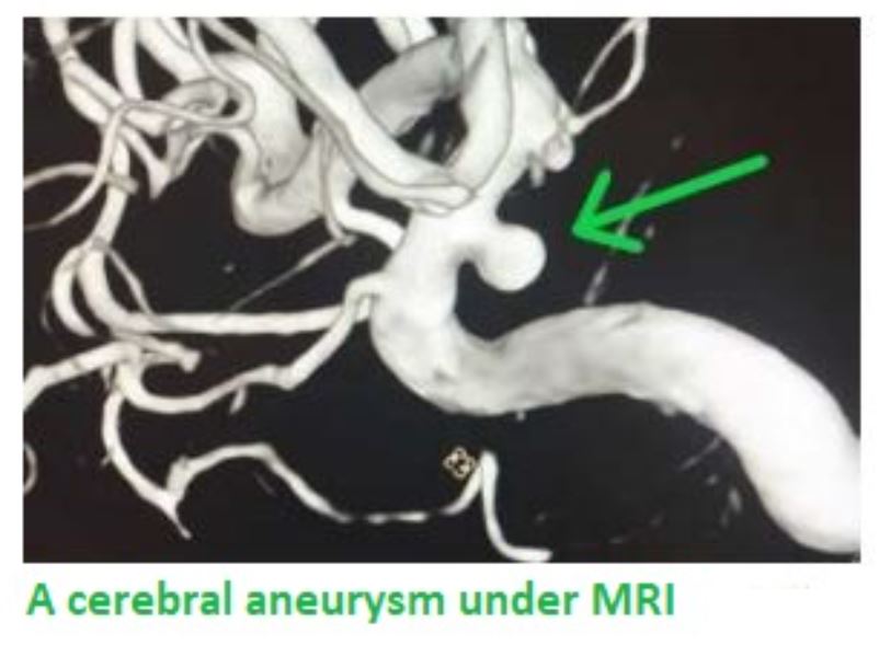 뇌동맥류_MRI