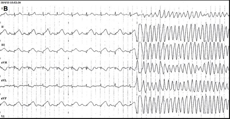 short coupling interval