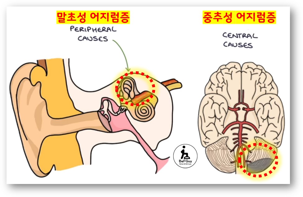 중추성 vs 말초성 어지럼증