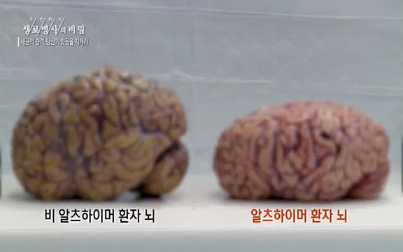 [792회] 생로병사의 비밀 - KBS[세균의 습격, 당신의 잇몸을 지켜라!] 감기보다 병원을 더 자주 찾게 만드는 질병이 있다. 바로 치주질환이다. 2020년 외래 다빈도 질병 1위를 차지한 치은염 및 치주질환 환자는 1,637_20220505_140921.448.jpg