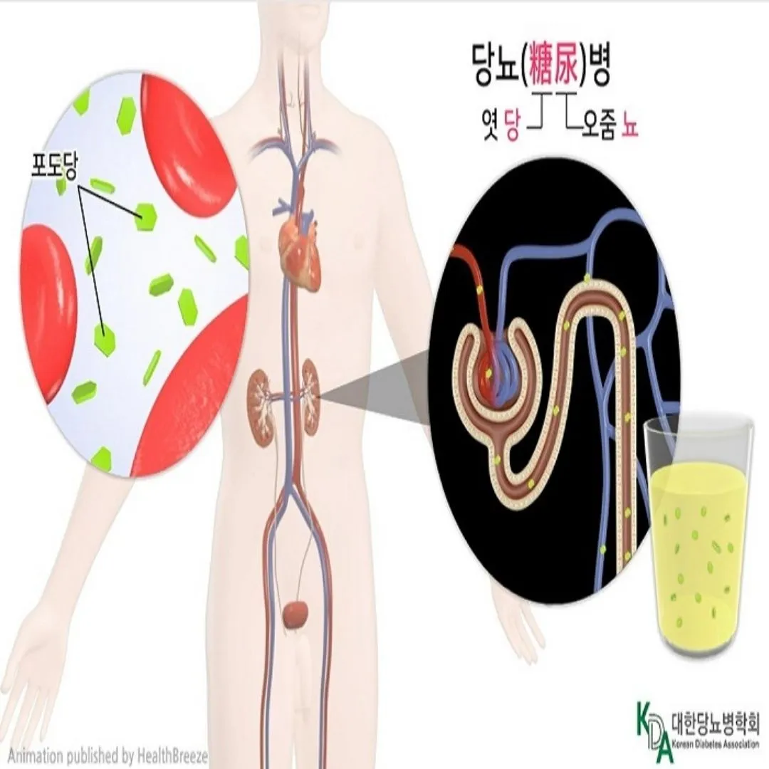 당뇨병 초기증상&amp;#44; 당뇨에 좋은음식