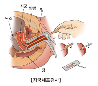 자궁