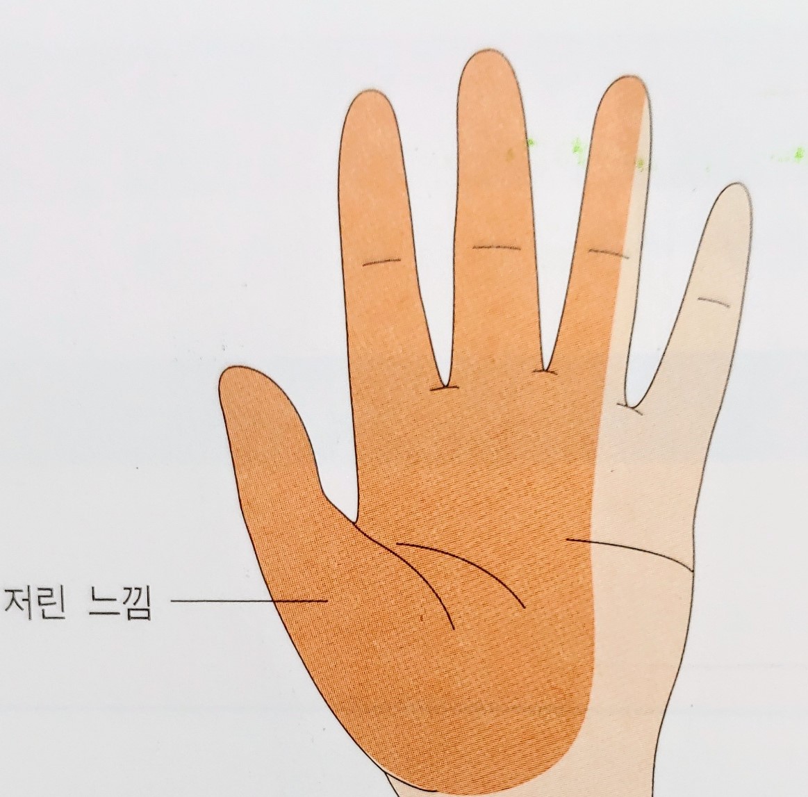  손목터널증후군(CTS) 원인, 증상, 자가진단 및 치료 총정리