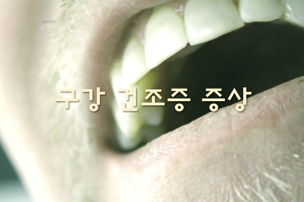  구강 건조증 증상과 치료 방법